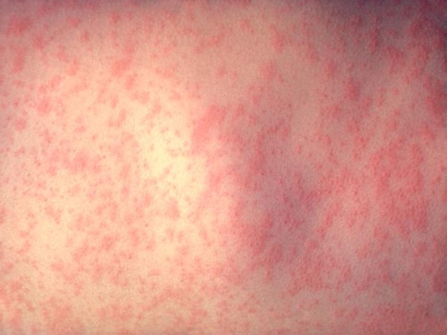 Measles outbreak: 11 cases confirmed in Arizona
